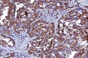 IHC staining of FFPE human ovarian cancer tissue with HRS antibody. HIER: boil tissue sections in pH8 EDTA for 20 min and allow to cool before testing.