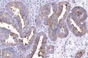 IHC staining of FFPE human endometrial cancer tissue with HRS antibody. HIER: boil tissue sections in pH8 EDTA for 20 min and allow to cool before testing.