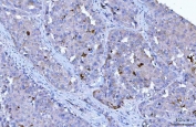 IHC staining of FFPE human hepatocellular carcinoma tissue with HRS antibody. HIER: boil tissue sections in pH8 EDTA for 20 min and allow to cool before testing.