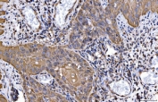 IHC staining of FFPE human laryngeal squamous cell carcinoma tissue with HGF-regulated tyrosine kinase substrate antibody. HIER: boil tissue sections in pH8 EDTA for 20 min and allow to cool before testing.
