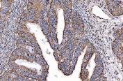 IHC staining of FFPE human endometrial cancer tissue with HGF-regulated tyrosine kinase substrate antibody. HIER: boil tissue sections in pH8 EDTA for 20 min and allow to cool before testing.