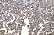 IHC staining of FFPE human ovarian cancer tissue with HGF-regulated tyrosine kinase substrate antibody. HIER: boil tissue sections in pH8 EDTA for 20 min and allow to cool before testing.