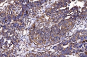 IHC staining of FFPE human bladder epithelial carcinoma tissue with HGF-regulated tyrosine kinase substrate antibody. HIER: boil tissue sections in pH8 EDTA for 20 min and allow to cool before testing.