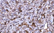 IHC staining of FFPE human breast infiltrating ductal carcinoma tissue with HGF-regulated tyrosine kinase substrate antibody. HIER: boil tissue sections in pH8 EDTA for 20 min and allow to cool before testing.