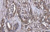 IHC staining of FFPE human colorectal adenocarcinoma tissue with HGF-regulated tyrosine kinase substrate antibody. HIER: boil tissue sections in pH8 EDTA for 20 min and allow to cool before testing.