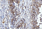 IHC staining of FFPE human bladder epithelial carcinoma tissue with YWHAE antibody. HIER: boil tissue sections in pH8 EDTA for 20 min and allow to cool before testing.