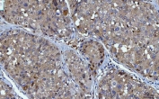 IHC staining of FFPE human liver cancer tissue with YWHAE antibody. HIER: boil tissue sections in pH8 EDTA for 20 min and allow to cool before testing.