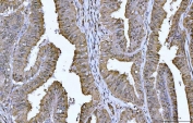 IHC staining of FFPE human endometrial cancer tissue with YWHAE antibody. HIER: boil tissue sections in pH8 EDTA for 20 min and allow to cool before testing.