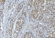 IHC staining of FFPE human colorectal adenocarcinoma tissue with YWHAE antibody. HIER: boil tissue sections in pH8 EDTA for 20 min and allow to cool before testing.