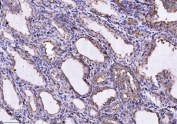 IHC staining of FFPE human thyroiditis tissue with ANXA4 antibody. HIER: boil tissue sections in pH8 EDTA for 20 min and allow to cool before testing.