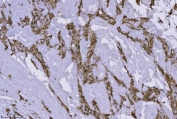 IHC staining of FFPE human leiomyoma of the vulva tissue with ANXA4 antibody. HIER: boil tissue sections in pH8 EDTA for 20 min and allow to cool before testing.
