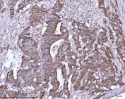 IHC staining of FFPE human colorectal adenocarcinoma tissue with Amiloride binding protein 1 antibody. HIER: boil tissue sections in pH8 EDTA for 20 min and allow to cool before testing.