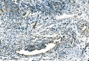 IHC staining of FFPE human cervical cancer tissue with C-C chemokine receptor type 2 antibody. HIER: boil tissue sections in pH8 EDTA for 20 min and allow to cool before testing.