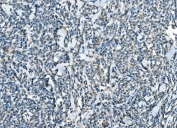 IHC staining of FFPE human lymphoma tissue with C-C chemokine receptor type 2 antibody. HIER: boil tissue sections in pH8 EDTA for 20 min and allow to cool before testing.