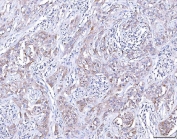 IHC staining of FFPE human lymphoma tissue with CCR7 antibody. HIER: boil tissue sections in pH8 EDTA for 20 min and allow to cool before testing.
