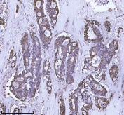 IHC staining of FFPE human colorectal adenocarcinoma tissue with SCA2 antibody. HIER: boil tissue sections in pH8 EDTA for 20 min and allow to cool before testing.