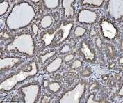 IHC staining of FFPE human thyroiditis tissue with SCA2 antibody. HIER: boil tissue sections in pH8 EDTA for 20 min and allow to cool before testing.