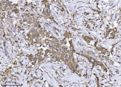 IHC staining of FFPE human breast cancer tissue with SCA2 antibody. HIER: boil tissue sections in pH8 EDTA for 20 min and allow to cool before testing.