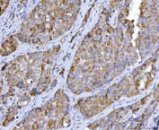 IHC staining of FFPE human hepatocellular carcinoma tissue with BECN1 antibody. HIER: boil tissue sections in pH8 EDTA for 20 min and allow to cool before testing.