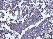 IHC staining of FFPE human lung cancer tissue with BECN1 antibody. HIER: boil tissue sections in pH8 EDTA for 20 min and allow to cool before testing.
