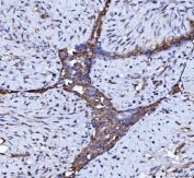 IHC staining of FFPE human breast cancer tissue with BECN1 antibody. HIER: boil tissue sections in pH8 EDTA for 20 min and allow to cool before testing.