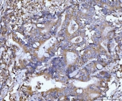 IHC staining of FFPE human colonic adenoma tissue with BECN1 antibody. HIER: boil tissue sections in pH8 EDTA for 20 min and allow to cool before testing.