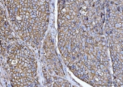 IHC staining of FFPE human hepatocellular carcinoma tissue with CD147 antibody. HIER: boil tissue sections in pH8 EDTA for 20 min and allow to cool before testing.
