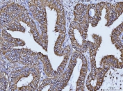 IHC staining of FFPE human endometrial cancer tissue with CD147 antibody. HIER: boil tissue sections in pH8 EDTA for 20 min and allow to cool before testing.