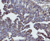 IHC staining of FFPE human bladder epithelial carcinoma tissue with CD147 antibody. HIER: boil tissue sections in pH8 EDTA for 20 min and allow to cool before testing.