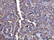 IHC staining of FFPE human ovarian cancer tissue with CD147 antibody. HIER: boil tissue sections in pH8 EDTA for 20 min and allow to cool before testing.