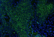 Immunofluorescent staining of FFPE human esophageal squamous carcinoma tissue with CD147 antibody (green) and DAPI nuclear stain (blue). HIER: boil tissue sections in pH8 EDTA for 20 min and allow to cool before testing.
