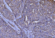 IHC staining of FFPE human hepatocellular carcinoma tissue with Emmprin antibody. HIER: boil tissue sections in pH8 EDTA for 20 min and allow to cool before testing.