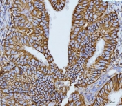 IHC staining of FFPE human endometrial cancer tissue with Emmprin antibody. HIER: boil tissue sections in pH8 EDTA for 20 min and allow to cool before testing.