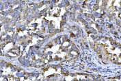 IHC staining of FFPE human ovarian cancer tissue with Emmprin antibody. HIER: boil tissue sections in pH8 EDTA for 20 min and allow to cool before testing.