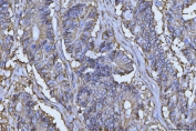 IHC staining of FFPE human colorectal adenocarcinoma tissue with Emmprin antibody. HIER: boil tissue sections in pH8 EDTA for 20 min and allow to cool before testing.