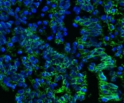 Immunofluorescent staining of FFPE human intestinal cancer tissue with Emmprin antibody (green) and DAPI nuclear stain (blue). HIER: steam section in pH8 EDTA buffer for 20 min.