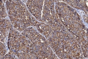 IHC staining of FFPE human liver cancer tissue with Basigin antibody. HIER: boil tissue sections in pH8 EDTA for 20 min and allow to cool before testing.