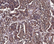 IHC staining of FFPE human colorectal adenocarcinoma tissue with Basigin antibody. HIER: boil tissue sections in pH8 EDTA for 20 min and allow to cool before testing.