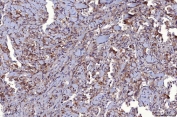 IHC staining of FFPE human breast infiltrating ductal carcinoma tissue with Basigin antibody. HIER: boil tissue sections in pH8 EDTA for 20 min and allow to cool before testing.