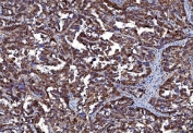 IHC staining of FFPE human ovarian cancer tissue with Basigin antibody. HIER: boil tissue sections in pH8 EDTA for 20 min and allow to cool before testing.