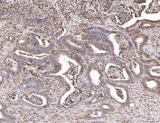 IHC staining of FFPE human colorectal cancer tissue with CBL antibody. HIER: boil tissue sections in pH8 EDTA for 20 min and allow to cool before testing.