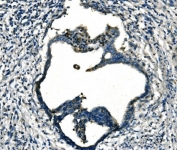 IHC staining of FFPE human cervical cancer tissue with Fibroblast growth factor 4 antibody. HIER: boil tissue sections in pH8 EDTA for 20 min and allow to cool before testing.