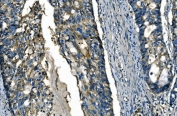 IHC staining of FFPE human adenocarcinoma of the right colon tissue with Fibroblast growth factor 4 antibody. HIER: boil tissue sections in pH8 EDTA for 20 min and allow to cool before testing.