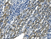IHC staining of FFPE human liver cancer tissue with Fibroblast growth factor 4 antibody. HIER: boil tissue sections in pH8 EDTA for 20 min and allow to cool before testing.