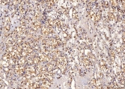 IHC staining of FFPE human renal clear cell carcinoma tissue with Sorbitol Dehydrogenase antibody. HIER: boil tissue sections in pH8 EDTA for 20 min and allow to cool before testing.