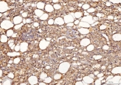 IHC staining of FFPE human SM fatty carcinoma of the left kidney tissue with Sorbitol Dehydrogenase antibody. HIER: boil tissue sections in pH8 EDTA for 20 min and allow to cool before testing.