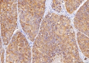 IHC staining of FFPE human liver cancer tissue with Sorbitol Dehydrogenase antibody. HIER: boil tissue sections in pH8 EDTA for 20 min and allow to cool before testing.