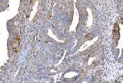 IHC staining of FFPE human endometrial cancer tissue with CD55 antibody. HIER: boil tissue sections in pH8 EDTA for 20 min and allow to cool before testing.