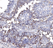 IHC staining of FFPE human bladder epithelial carcinoma tissue with CD55 antibody. HIER: boil tissue sections in pH8 EDTA for 20 min and allow to cool before testing.