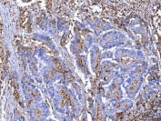 IHC staining of FFPE human colorectal adenocarcinoma tissue with CD55 antibody. HIER: boil tissue sections in pH8 EDTA for 20 min and allow to cool before testing.